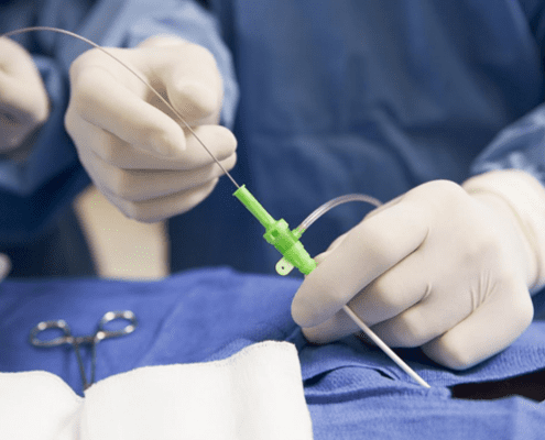 Katheterablation: neue Studiendaten zu LIXIANA®