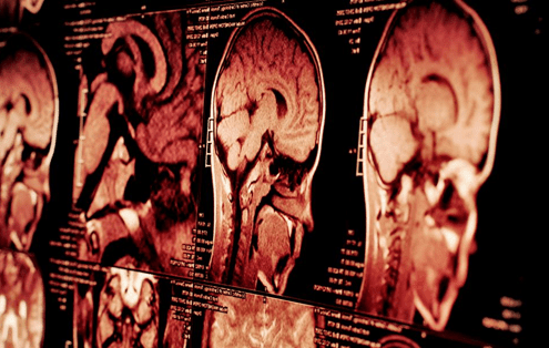 Zerebrale Mikroblutungen: Marker für ein erhöhtes intrakranielles Blutungsrisiko?
